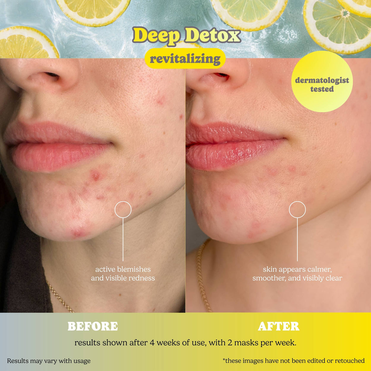 Bye Bye Breakouts Face Mask Kit